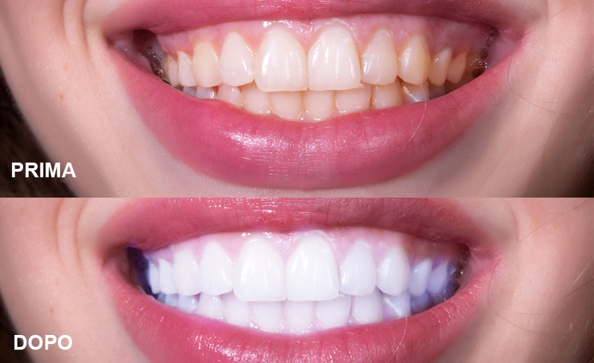 medicina-estetica-periorale-after-before